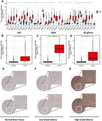 Prognostic Biomarker KIF18A and Its Correlations With Immune Infiltrates and Mitosis in Glioma